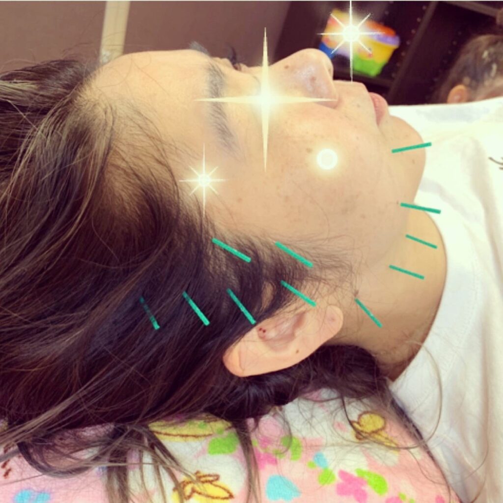 美容鍼でスッキリフェイスライン